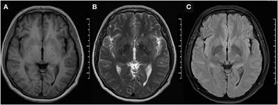 Case Report: Migraine-Induced Dystonia of the Lower Extremities